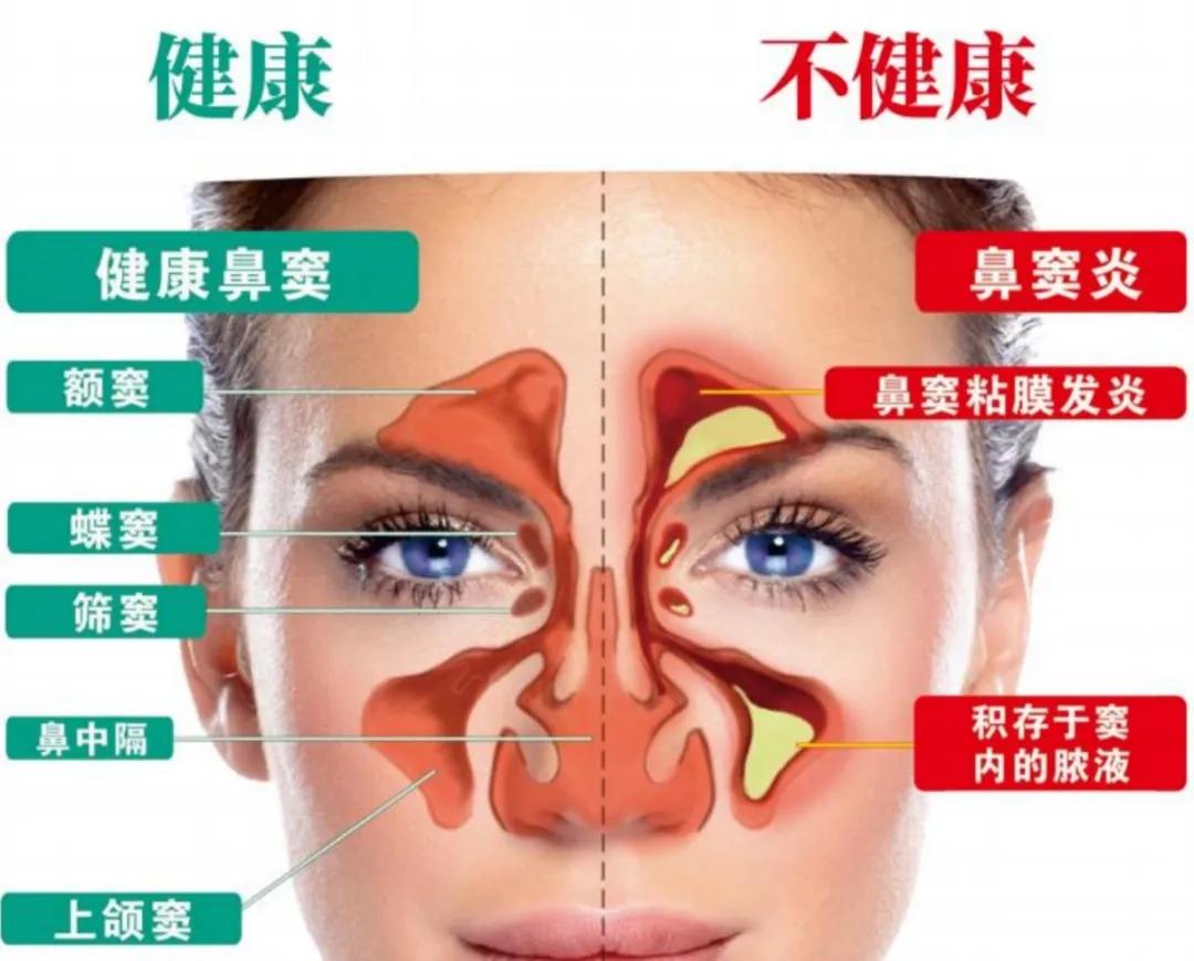 鼻炎总不好？问题出在鼻粘膜上！修复它，比乱吃药管用100倍

有没有发现，身边得