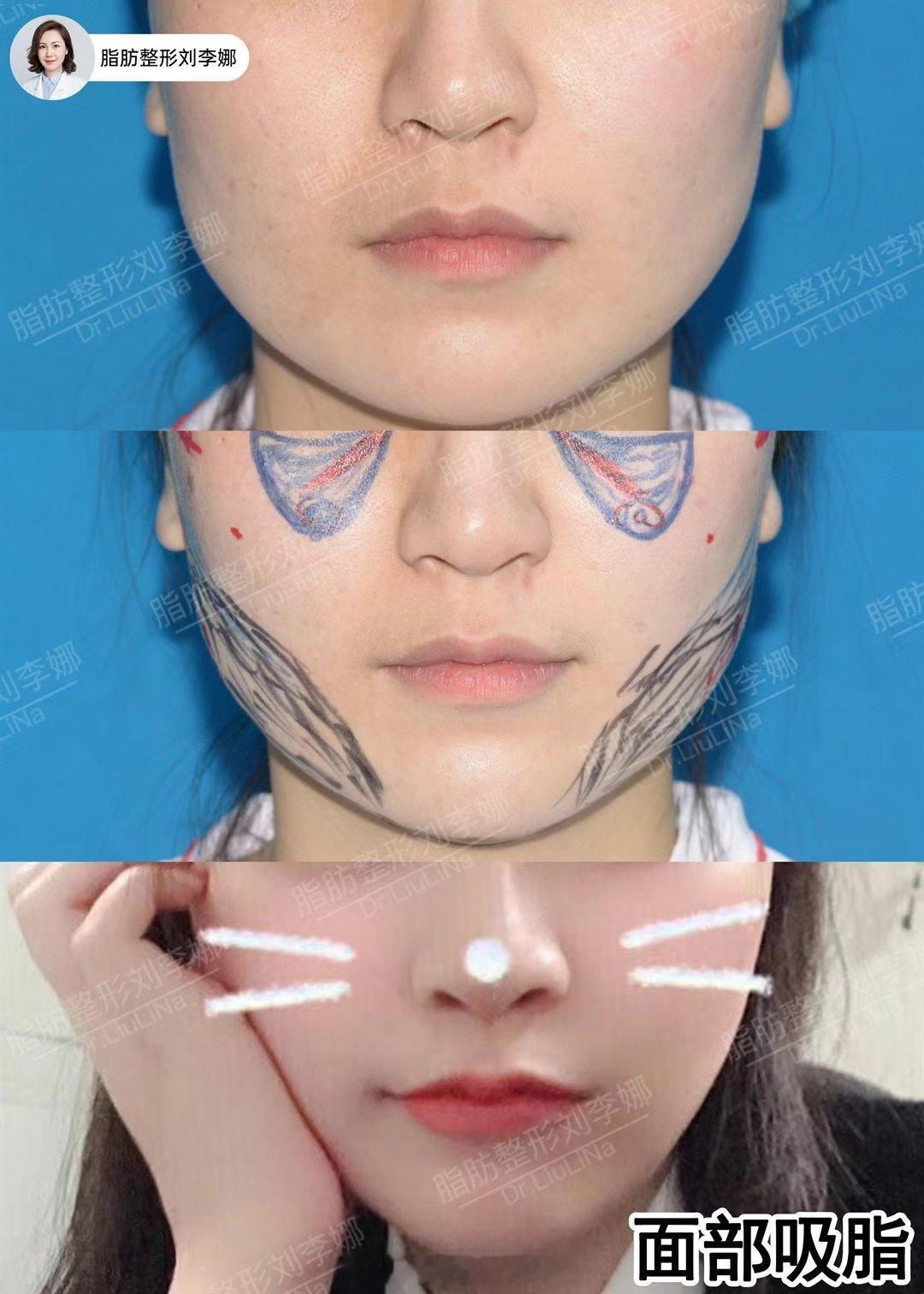 脂肪整形刘李娜双下巴吸脂下颌缘吸脂 面部吸脂术后反馈，宽脸变成了小v脸！ 