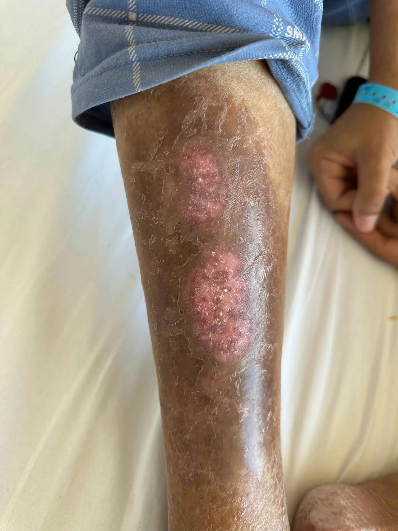 太可怕了！在医院候诊时发现邻座一位大约五十多岁的男士的双小腿皮肤都黑了，比附图还
