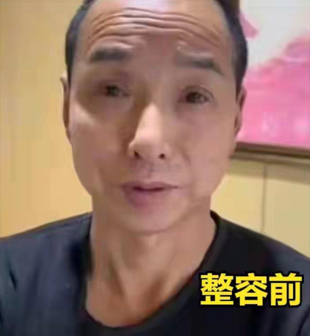 很少看到大龄男生整容的，皮肤变嫩了。 
