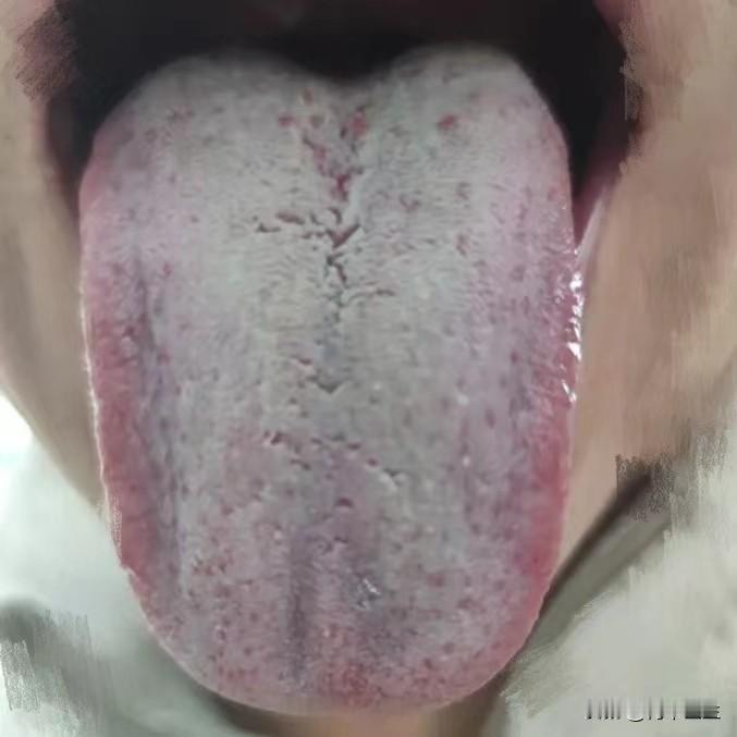 肝郁脾虚 湿气 瘀血 阴虚火旺
舌诊分析：湿气 瘀血 阴虚火旺 肝郁脾虚
1、“