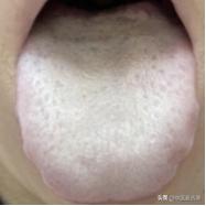 一补就上火，体内必有痰，这样的舌头上去就补阳，可就大错特错了
患者主诉：平时又特