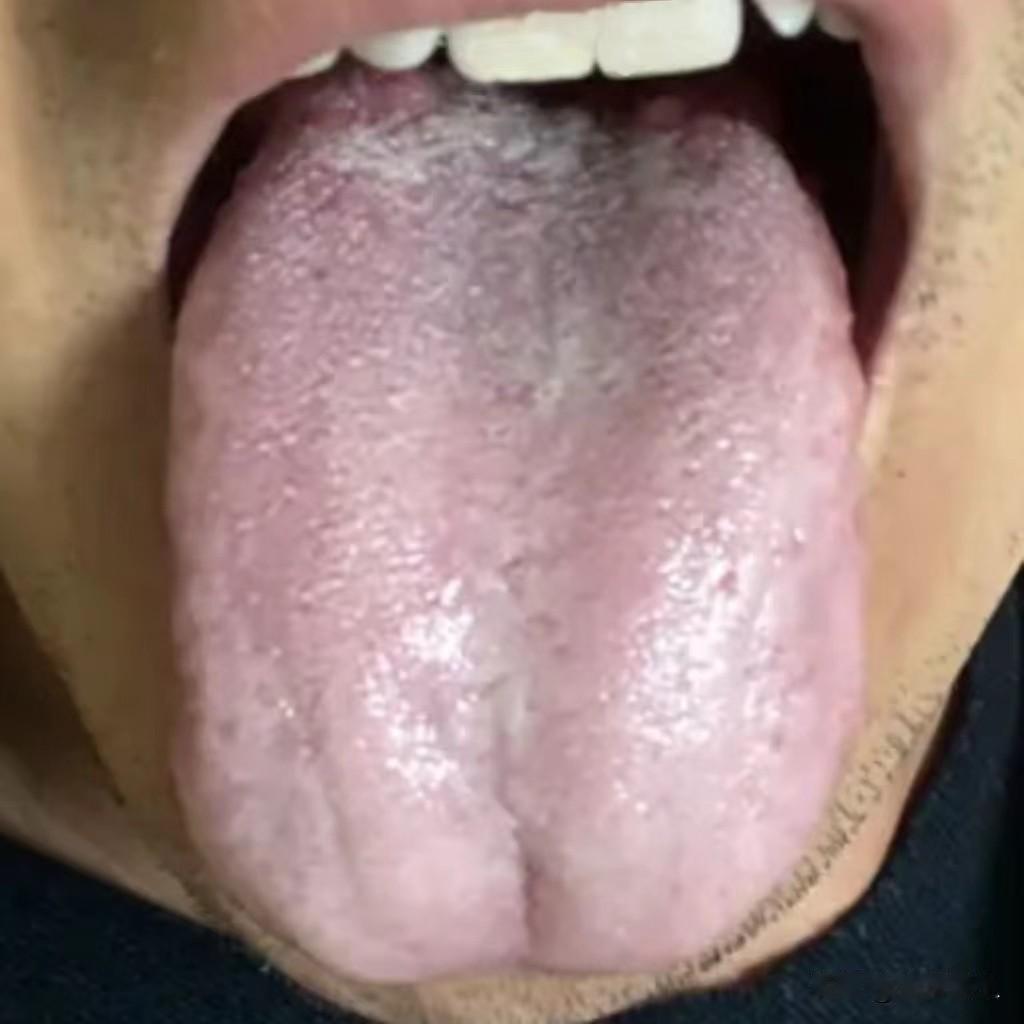 全身上下瘀阻不通，已经出现心悸气短的情况了！
这位患者是因为心悸气短，胸口憋闷来