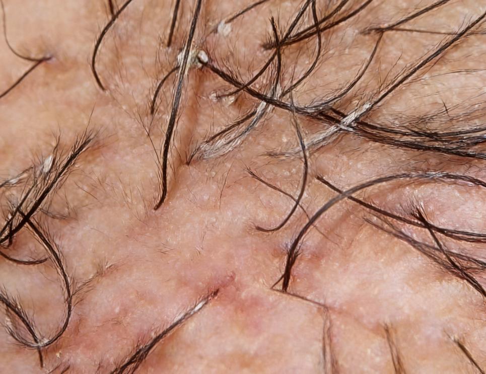 【患者提问】我一直不敢跟人说这个事。那天跟男友一起洗澡时，他发现我肛门附近长了不