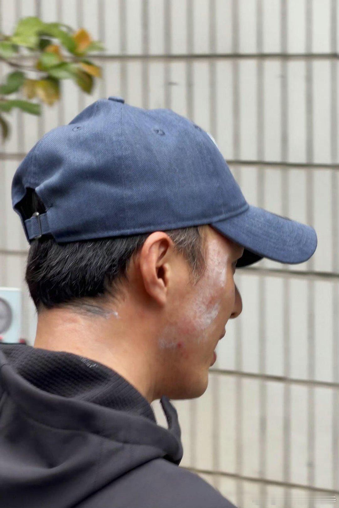 叶祖新的脸怎么了看起来是头套的胶水过敏了导致了。我发现叶祖新现在年纪大了演戏反而