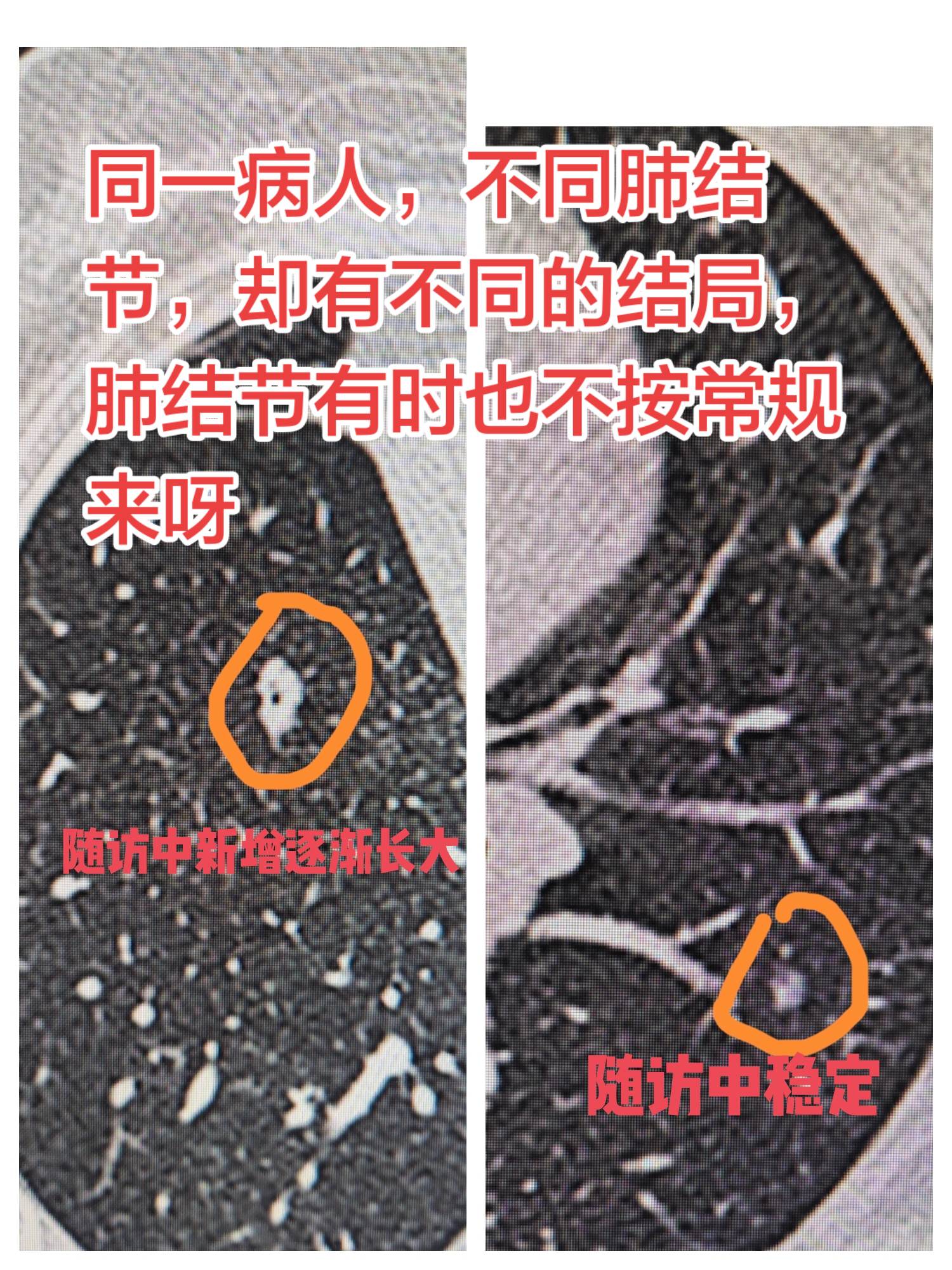 同一病人，不同肺结节的结局。同一病人，不同肺结节，却有不同的结局，肺结...