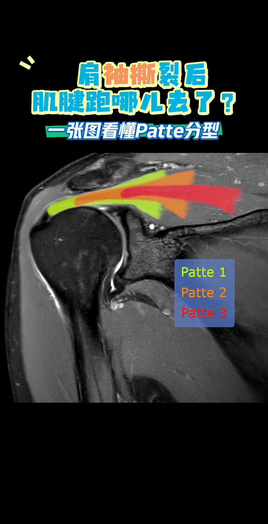 肩袖撕裂后肌腱跑哪儿去了？一张图看懂。肩袖撕裂了，肌腱不只是“断”，还...