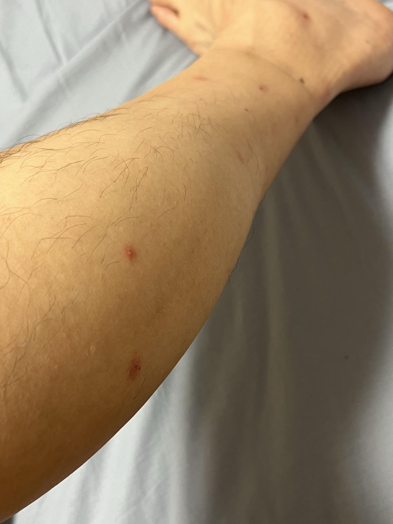 深圳什么都好，就是小黑蚊子实在太毒了。这已经回来这么多天了，被叮咬的包肿下去了，