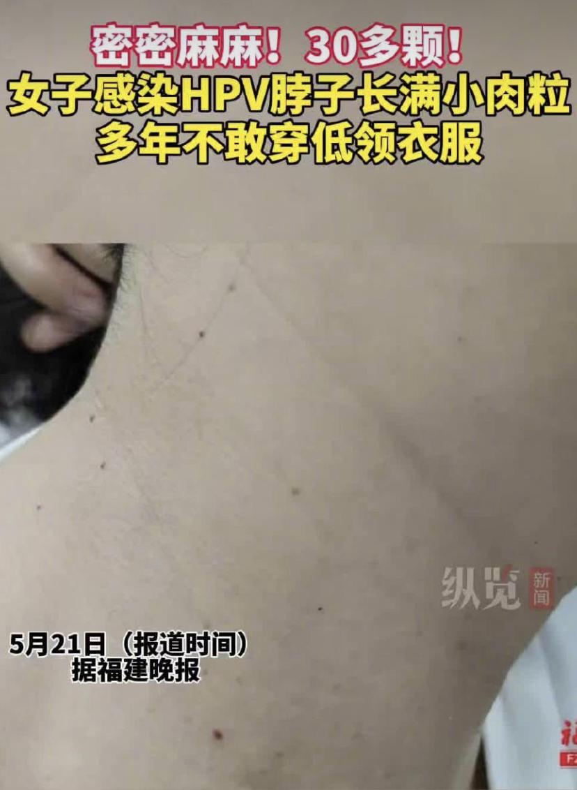 福州大姐脖子长"肉刺",3年变30多颗!医生：这东西会传染，别乱抠
福州42岁的