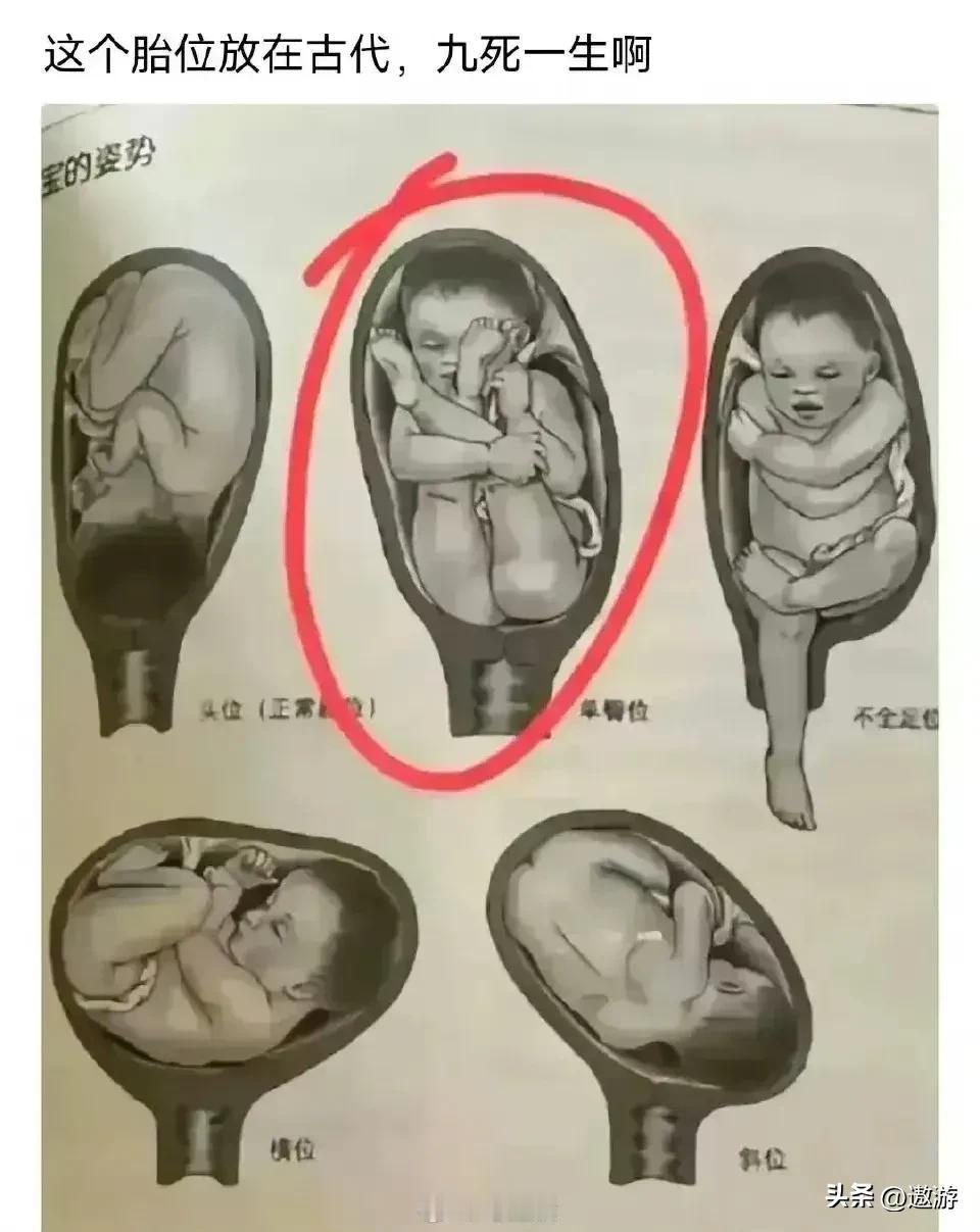 这胎位放古代真的九死一生！但中国史书浩如烟海，也有记载名人这样出生过，比如春秋第