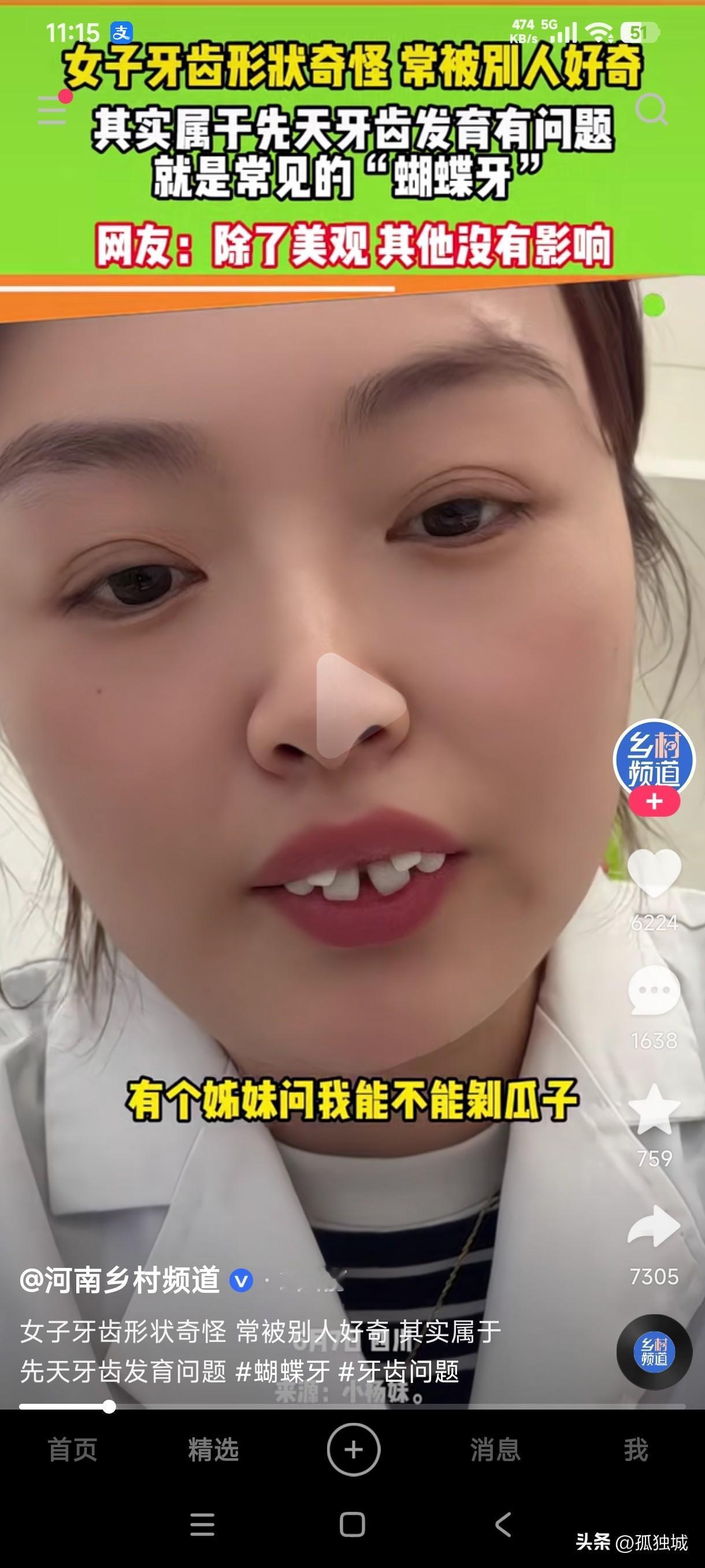 女子牙齿形状奇怪，经常被别人好奇，甚至有人问她这种天生发育成这样的蝴蝶牙能不能嗑