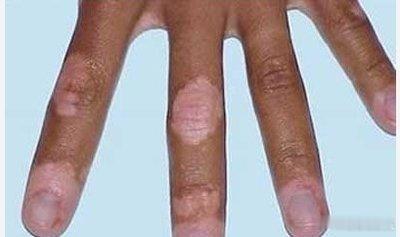 Nature子刊：白癜风可降低癌症风险！11月3日，发表在 Nature Com