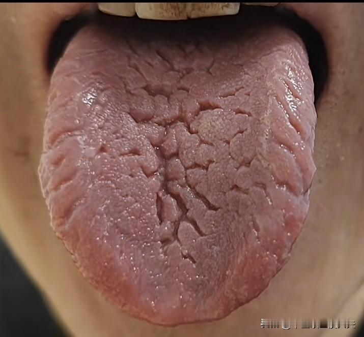 裂纹铺满舌面，还在傻傻补肾精，这两个地方不重视，再补也是白搭！[撇嘴]

很多人