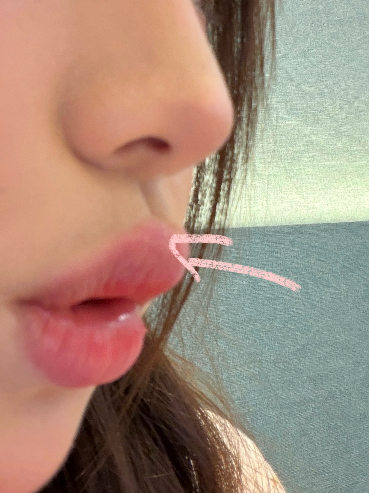 唇炎快半年没复发 今天竟然复发了 可能是用了新的唇釉导致的 泰国30来块钱的一支