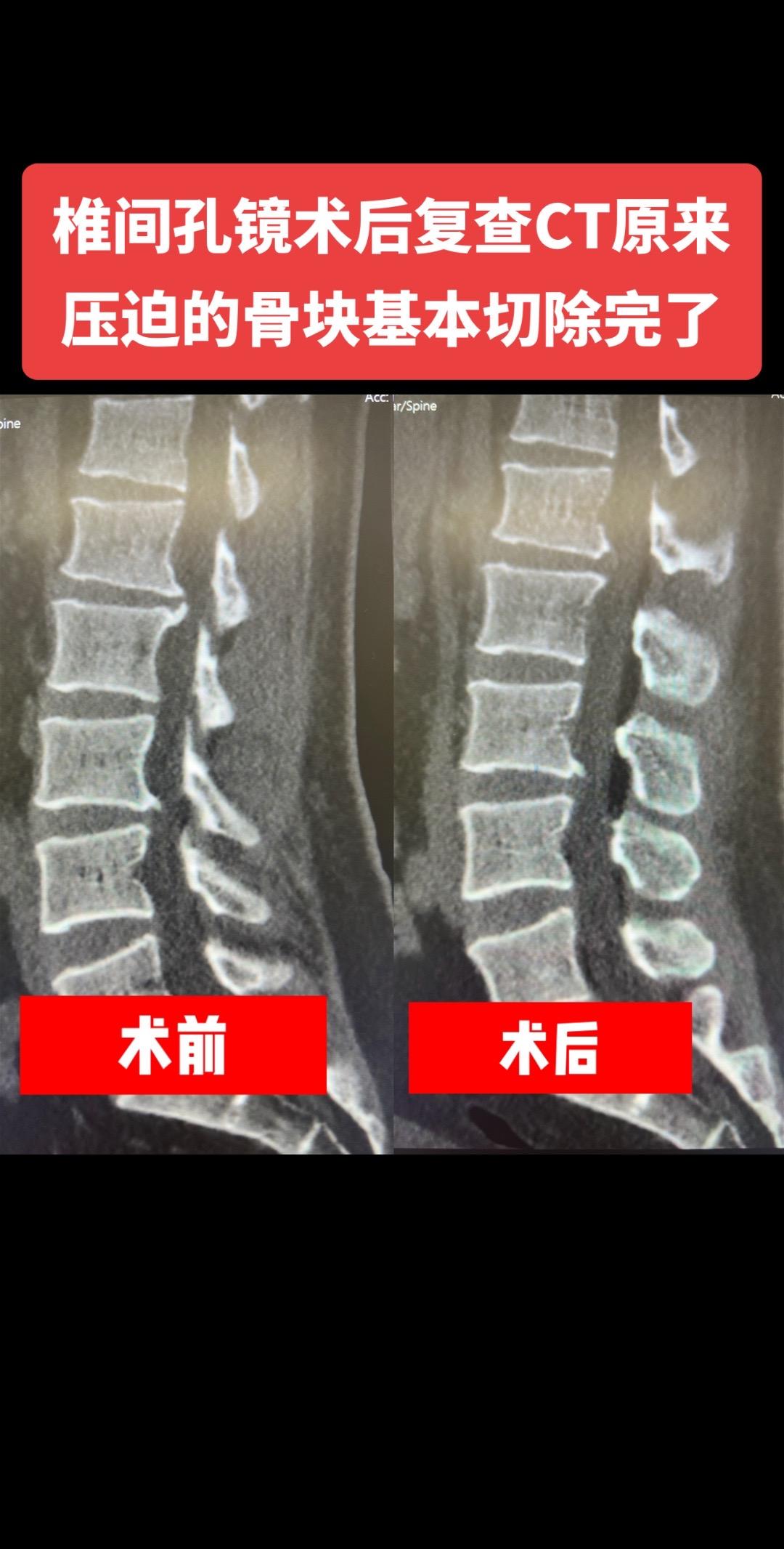 上次那个椎间盘突出合并钙化的病人，术后CT显示钙化的椎间盘基本切除干净...