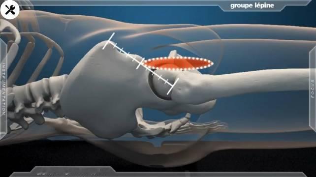#缺血性股骨头坏死是什么病##刘欢去世#【3D医学动画演示：股骨头坏死，人工髋关节置换手术全过程】
