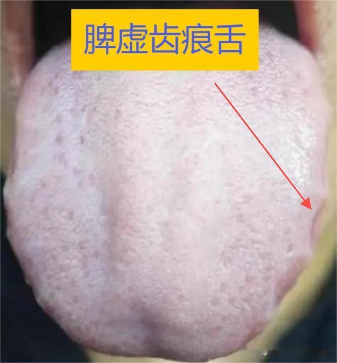 常见的齿痕舌有3种，只有1种是湿气太重，千万别搞错了！

1、脾虚齿痕舌。

辩
