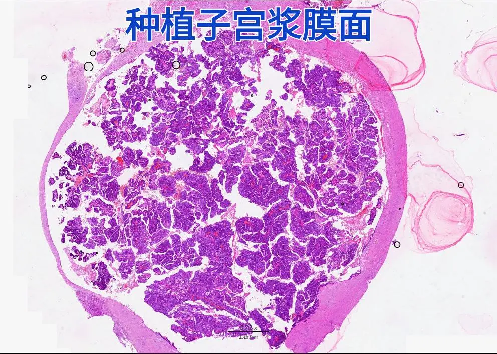 卵巢癌