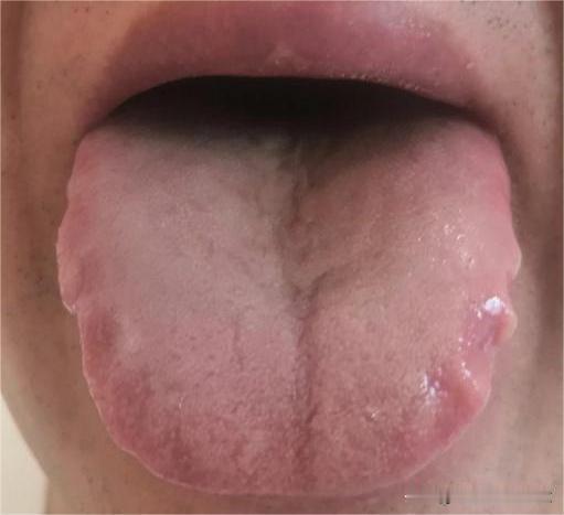 齿痕这么明显，湿气这么重，脾胃能好吗[what][what]
大哥说自己总是喝酒