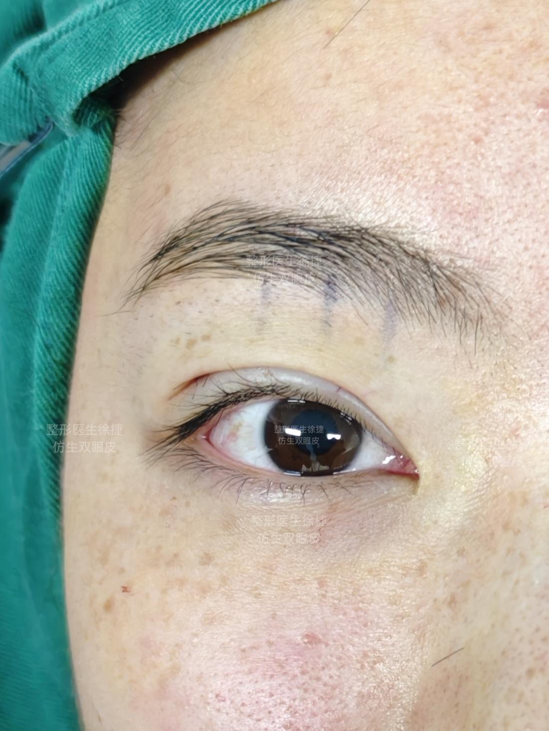 刚做好，你喜欢这样的双眼皮吗。努力做疤痕不明显，动态且自然的双眼皮