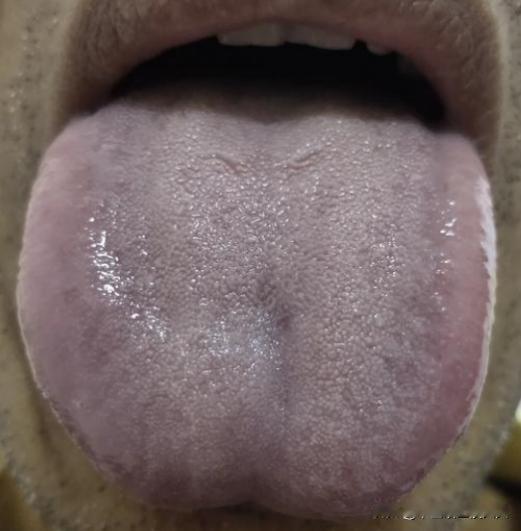 人过40，阳气始衰！一看舌头，多是脾肾阳虚，教你1招 先通再补
这位男性粉丝，之