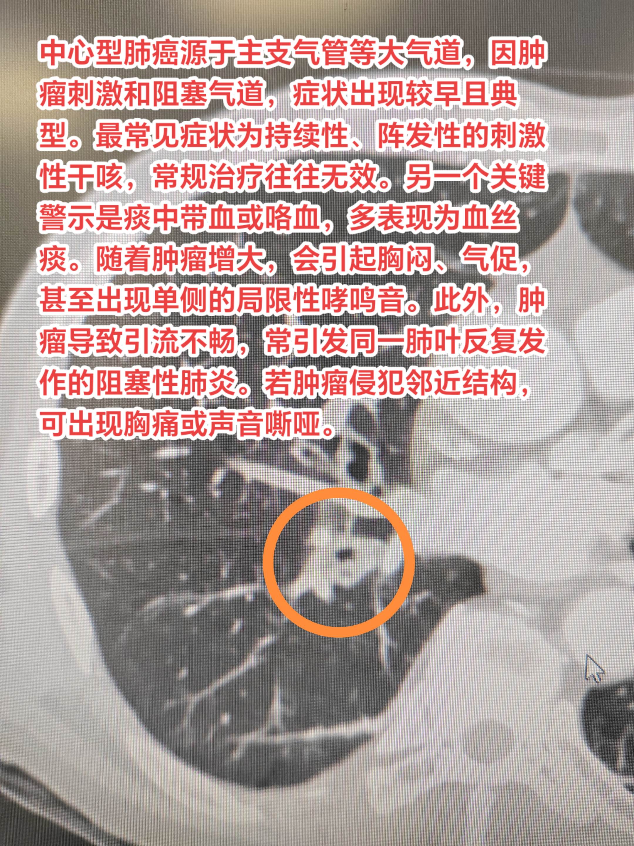 干咳、痰中带血、胸闷气短要小心中心型肺癌。中心型肺癌源于主支气管等大气...