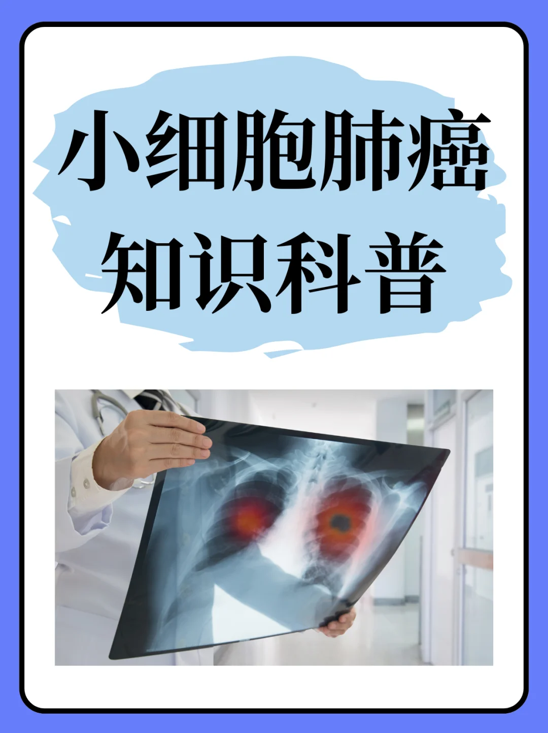 小细胞肺癌知识科普