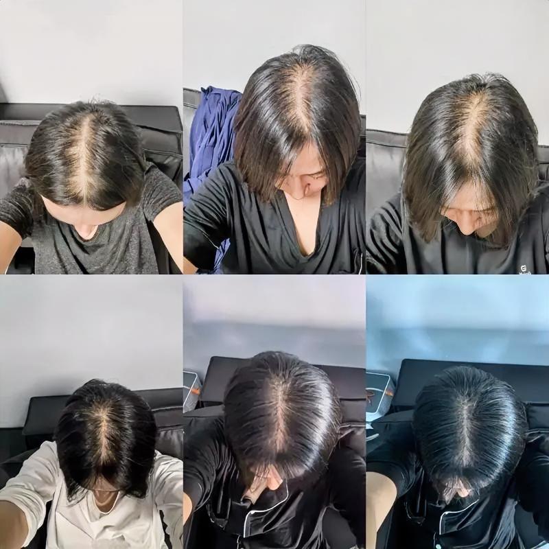 已经二零二六年了，医学这么发达，为什么脱发问题还解决不了[捂脸]脱发的办法 脱发