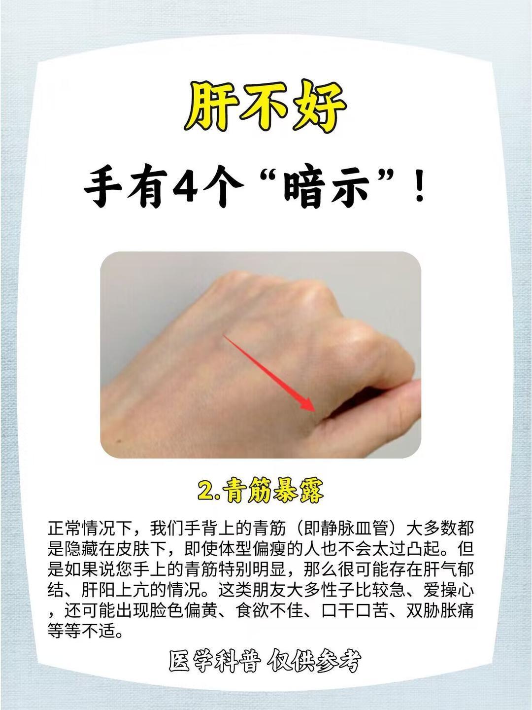 肝不好，看看手就知道，快来检查一下！ ​​​
