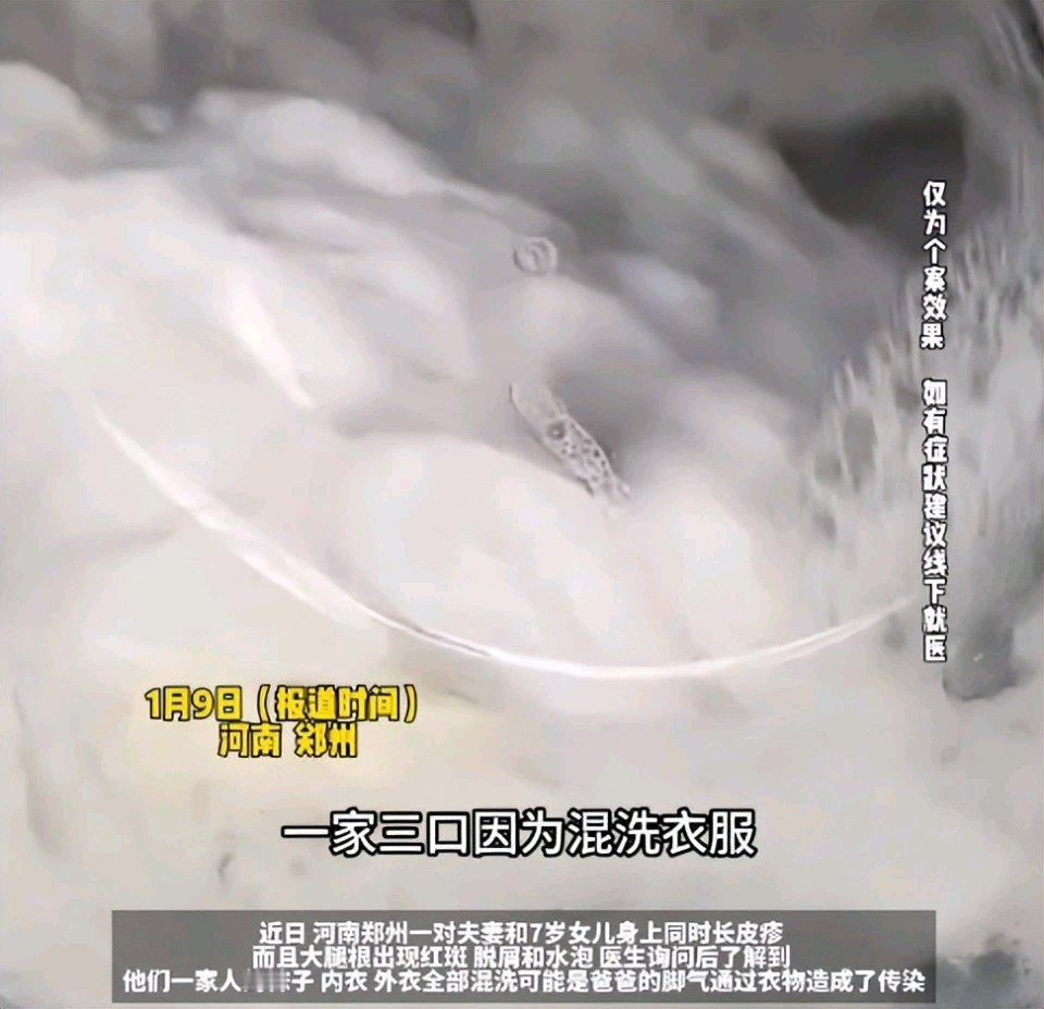 这事儿太离谱了！袜子和内衣混洗，爸爸的脚气直接传给全家，7岁女儿都中招了，医生还