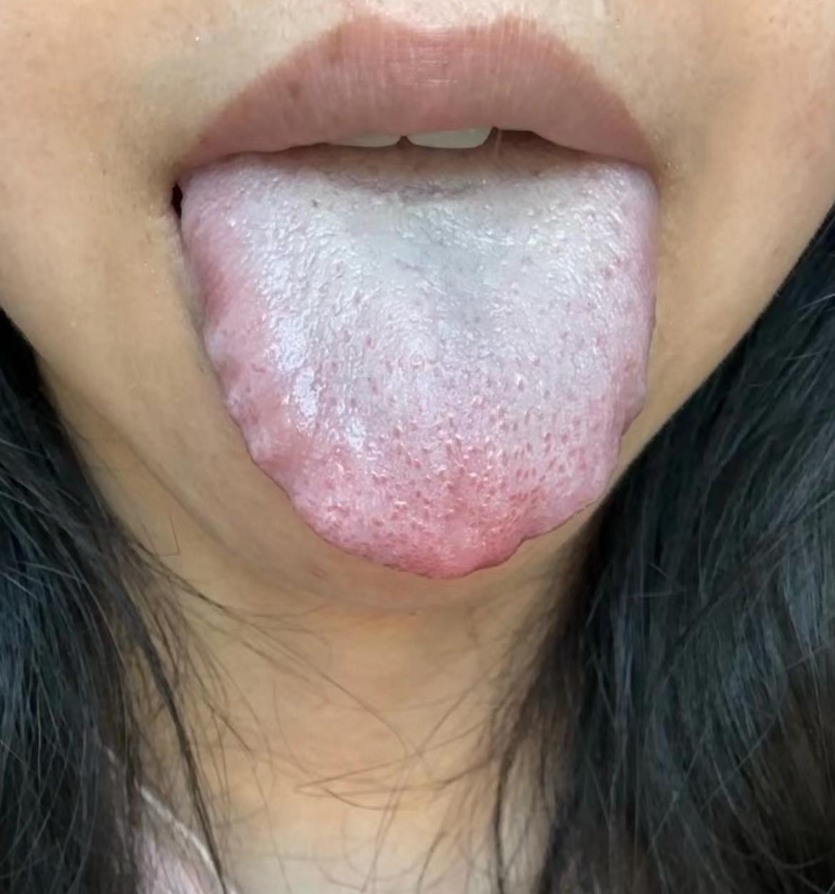舌头没血色，齿痕绕舌一圈，能有精神才怪啊！
她不仅是气血不足了，阳虚也有，脾虚也