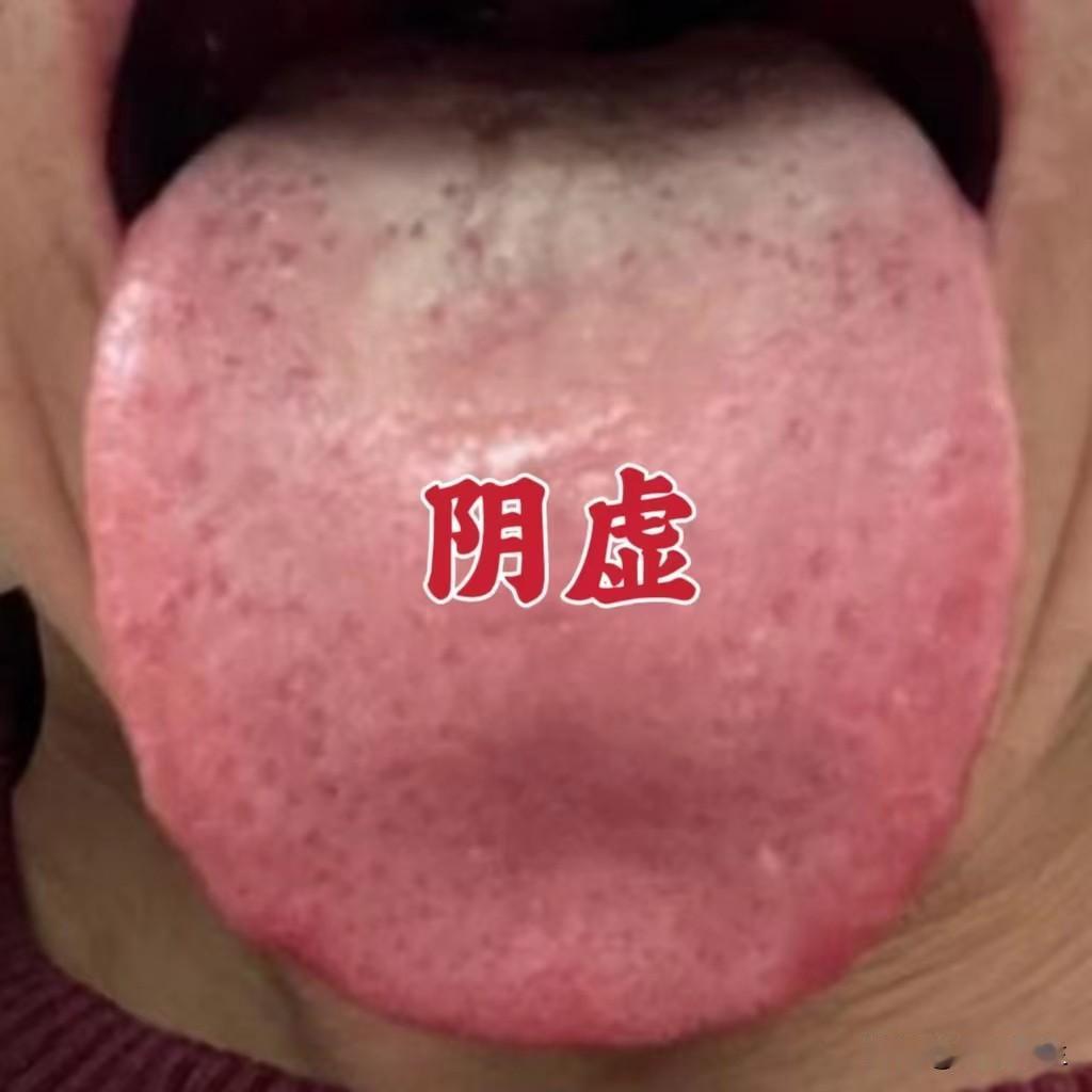 今日舌象总结：
（一）阴虚
症状：舌色红绛，舌苔偏少，舌尖红点，舌边红点、鼓胀，