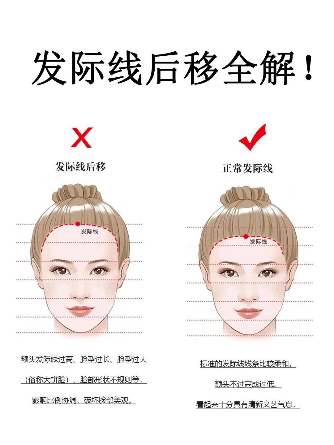 #发际线高低真的会影响颜值吗#原来我是因为这些原因导致的发际线后移啊！ ​​​