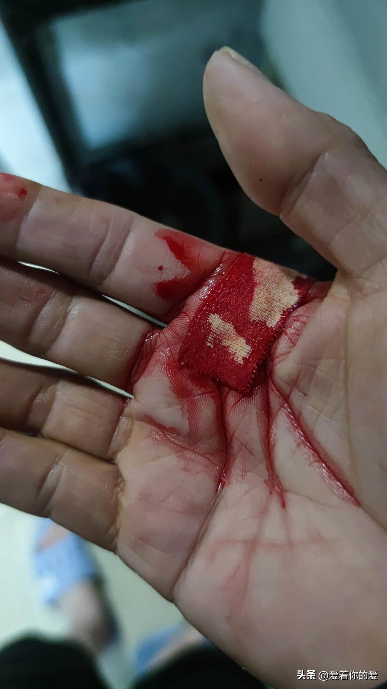 生活中，不经意间受伤的情况实在是屡见不鲜。就拿谭耀文拍戏来说，拍打戏时稍不留意，