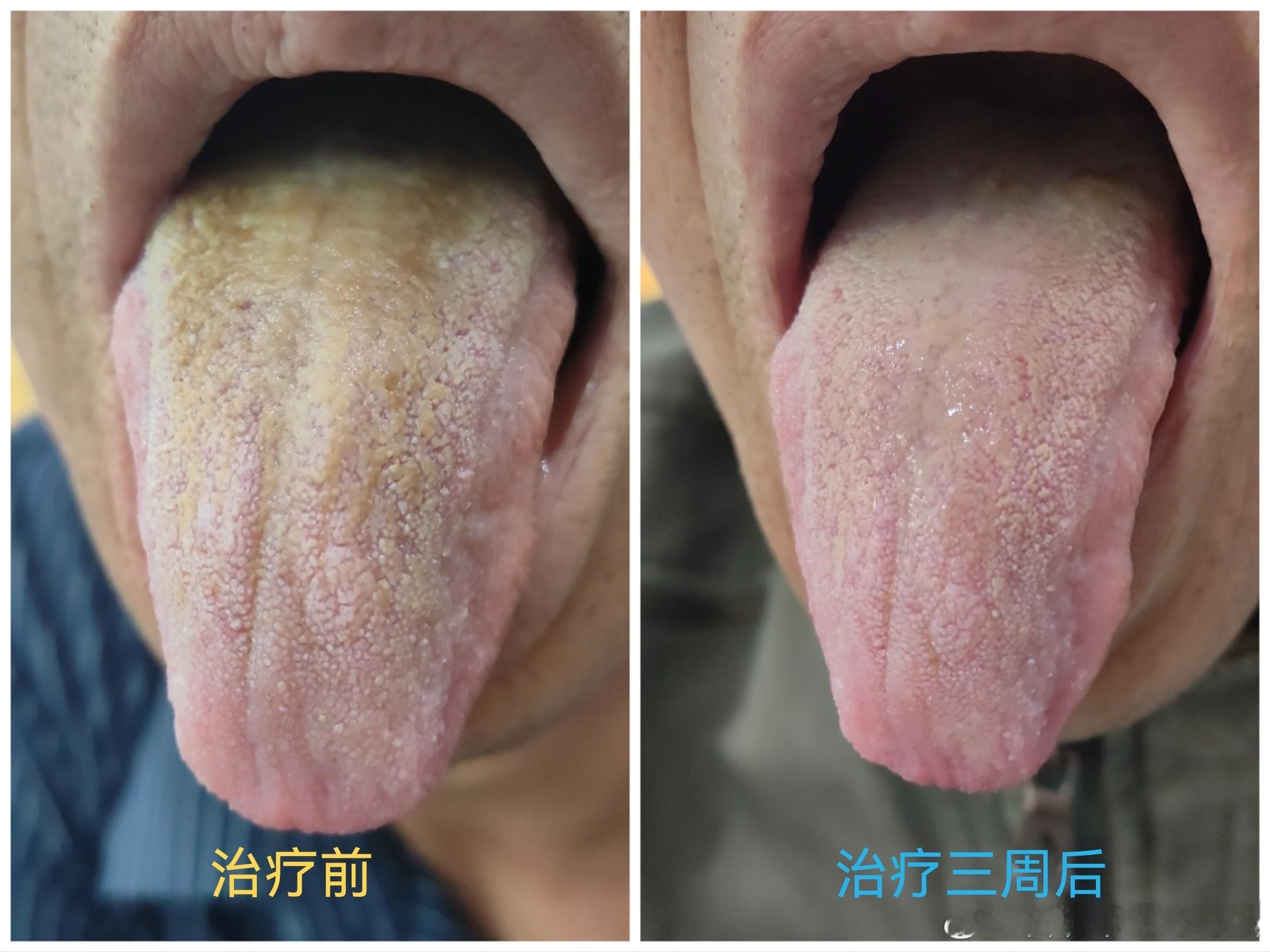 顽疾终愈：历时一年的反酸之困终得解患者饱受胃病困扰多年，近一年来病情显著加剧。胃