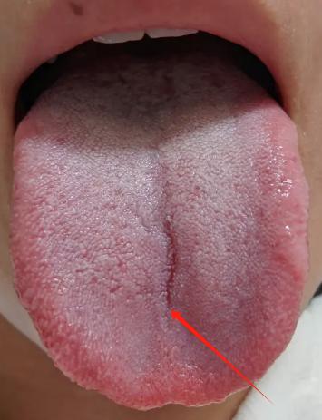 今天，我要和大家分享一种让人头疼的舌象
你看这舌头，红红的舌边仿佛心里有一团火在