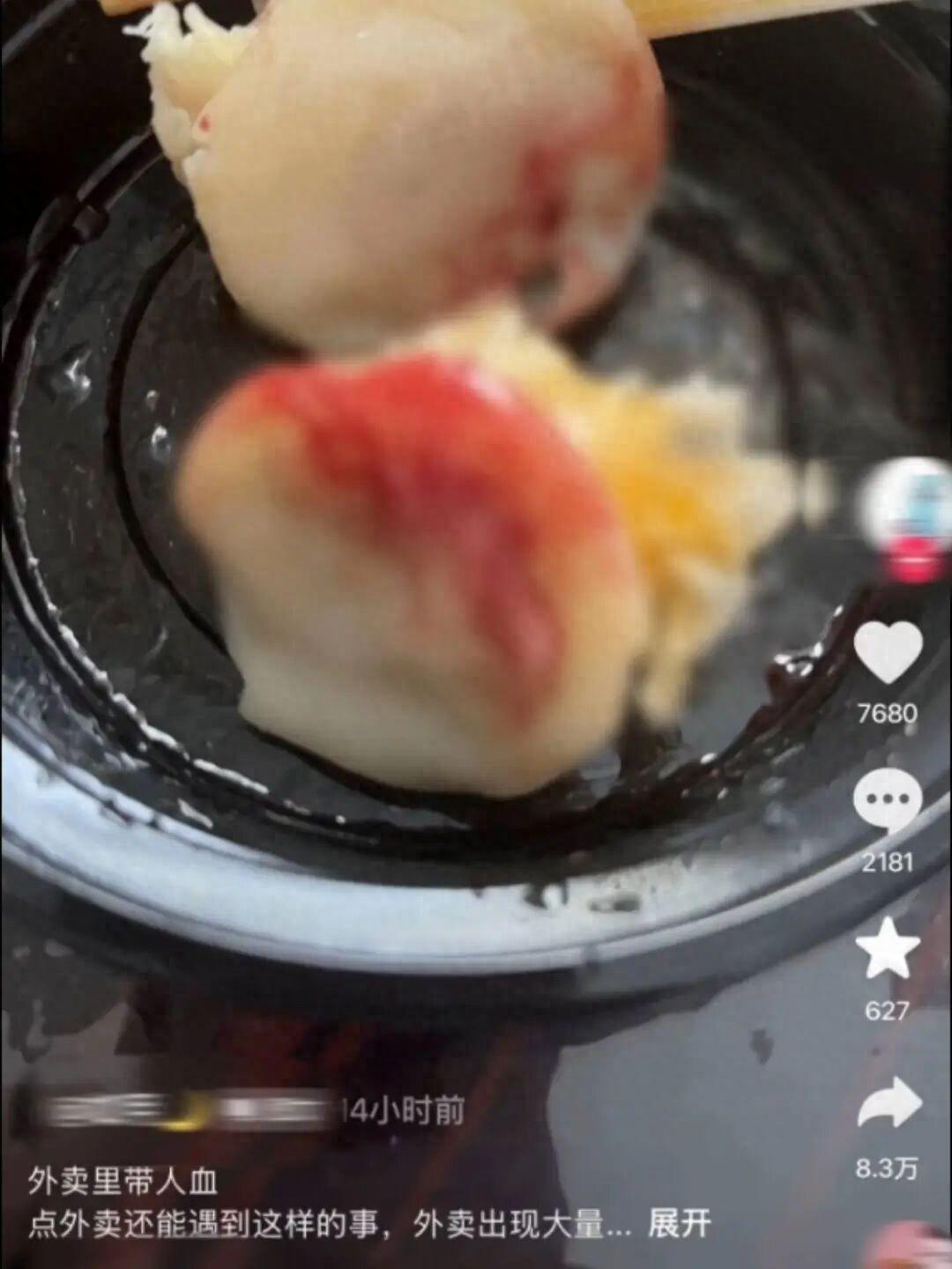 外卖烧卖里吃出大量血迹，报警后服用阻断药，店员承认是自己的血但拒做检查，当地市监