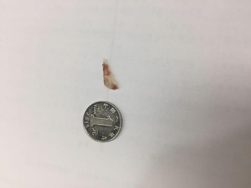 广西一镇政府职员杨某，2022年4月24日中午在岳父母家吃饭时被鱼刺卡喉，自行处