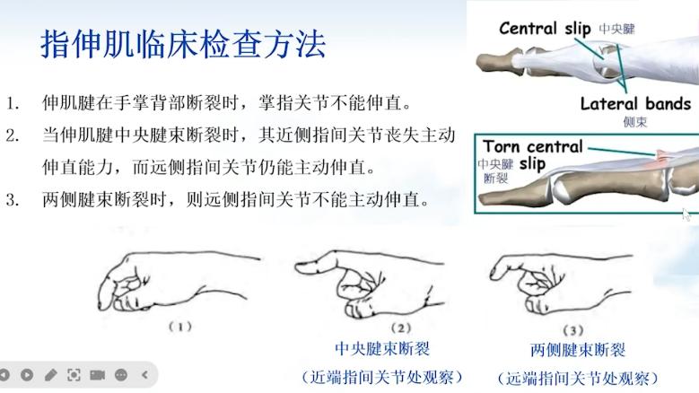 手外伤超声。指伸肌、指屈肌超声
