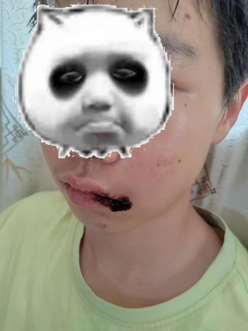 丢了两颗牙，嘴唇缝了几针，几天都吃饭睁不开嘴巴，医院还住院不了。怎么办牙硌掉了 