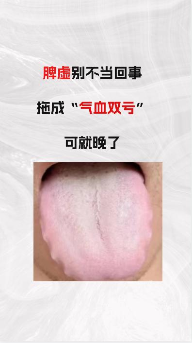 脾虚  别不当回事，拖成“气血双亏”可就晚了