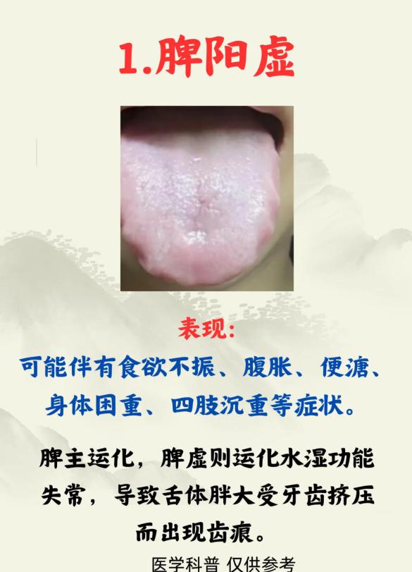 齿痕舌的 5 大类型，看舌头就知道你是哪一种