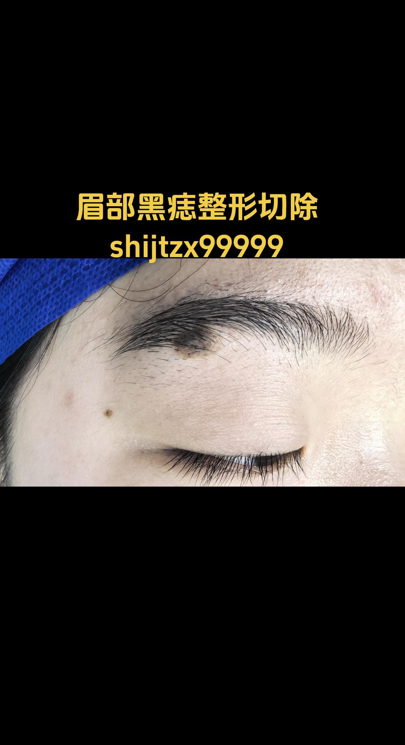 眉部黑痣。眉部出生时就有一颗黑痣，随年龄不断增大，到整形外科切除。