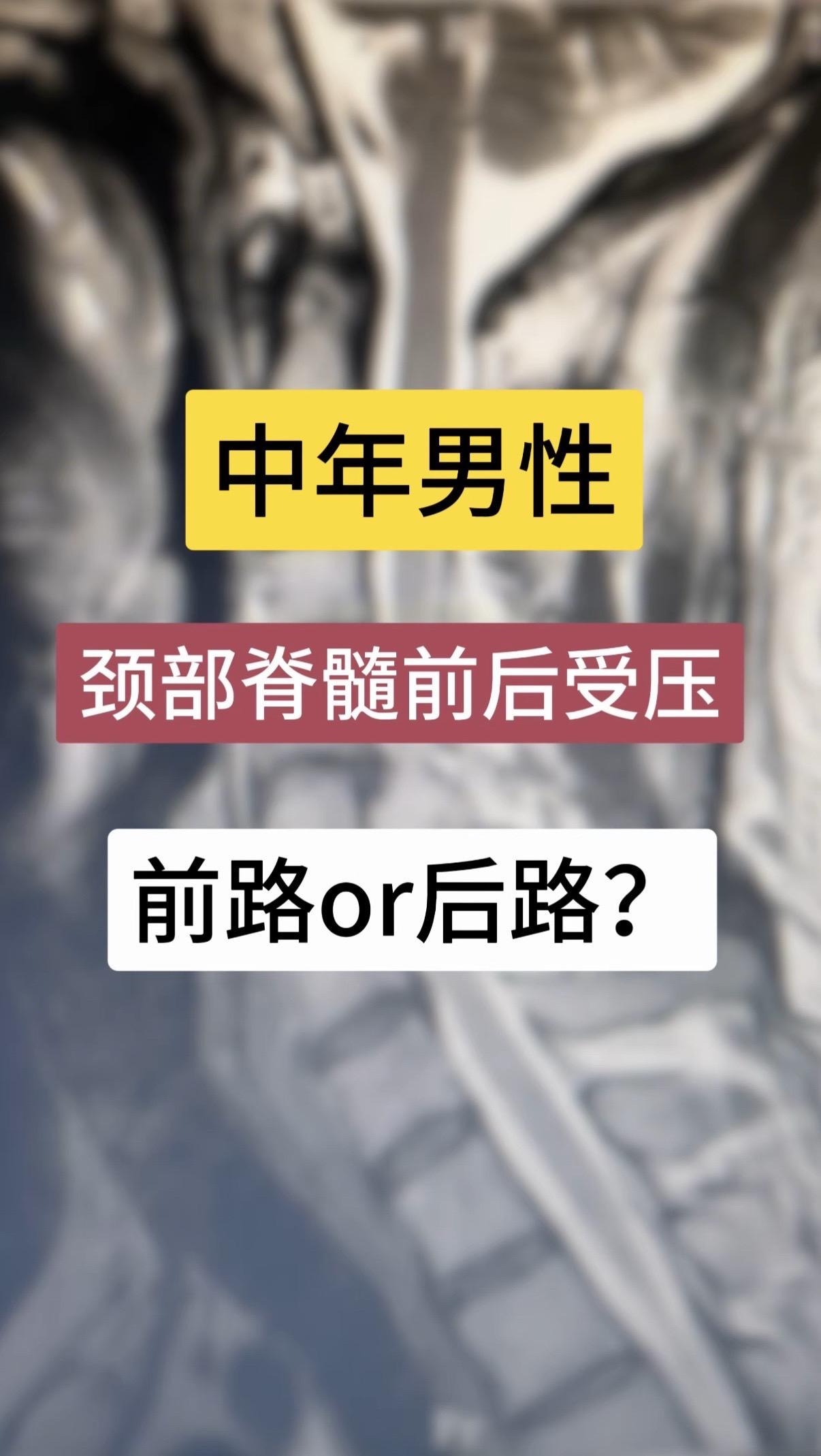 中年男性颈部脊髓前后受压，前路or后路？50岁男性，双下肢无力伴右上肢...