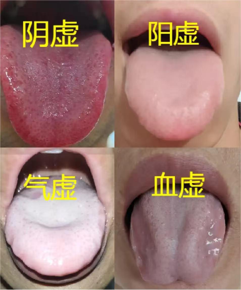 人体四大虚，阴虚、阳虚、气虚、血虚，你是哪一种？中医科普健康涨知识舌诊

1、阴