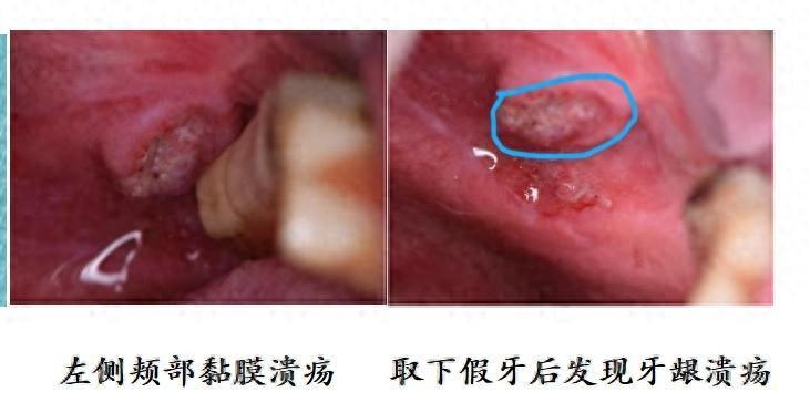 62岁男子口腔内查出癌变，致癌元凶竟是戴了两年的“日常用品”

62岁的李先生最