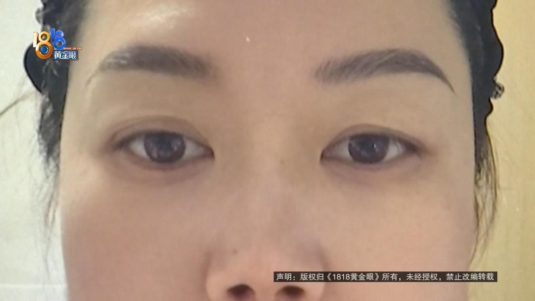 爱美反倒添了堵！浙江杭州，一女子原本左眼“双得很明显”，只是右眼皮有些松弛，两边