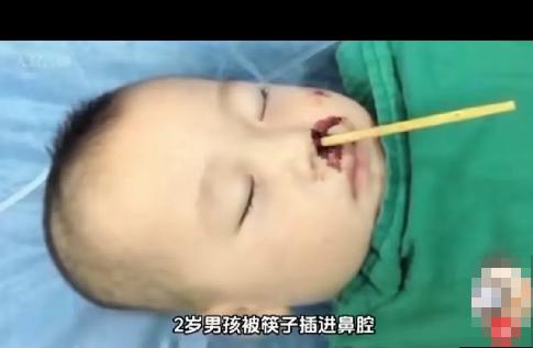 太痛心！爸爸接个电话的空档，两岁娃吃面摔一跤，筷子顺着鼻孔扎进大脑。过往多地也出