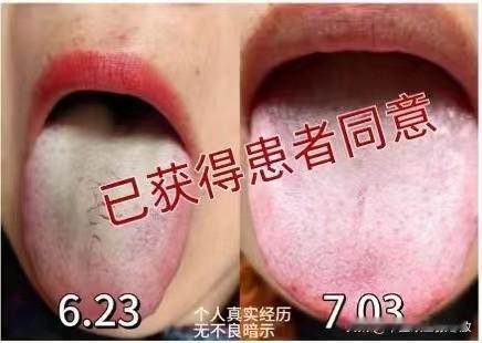 10天，2招将 “厚腻苔” 扫净！可别再说痰湿难除了

主诉：浑身乏力，犯困嗜睡