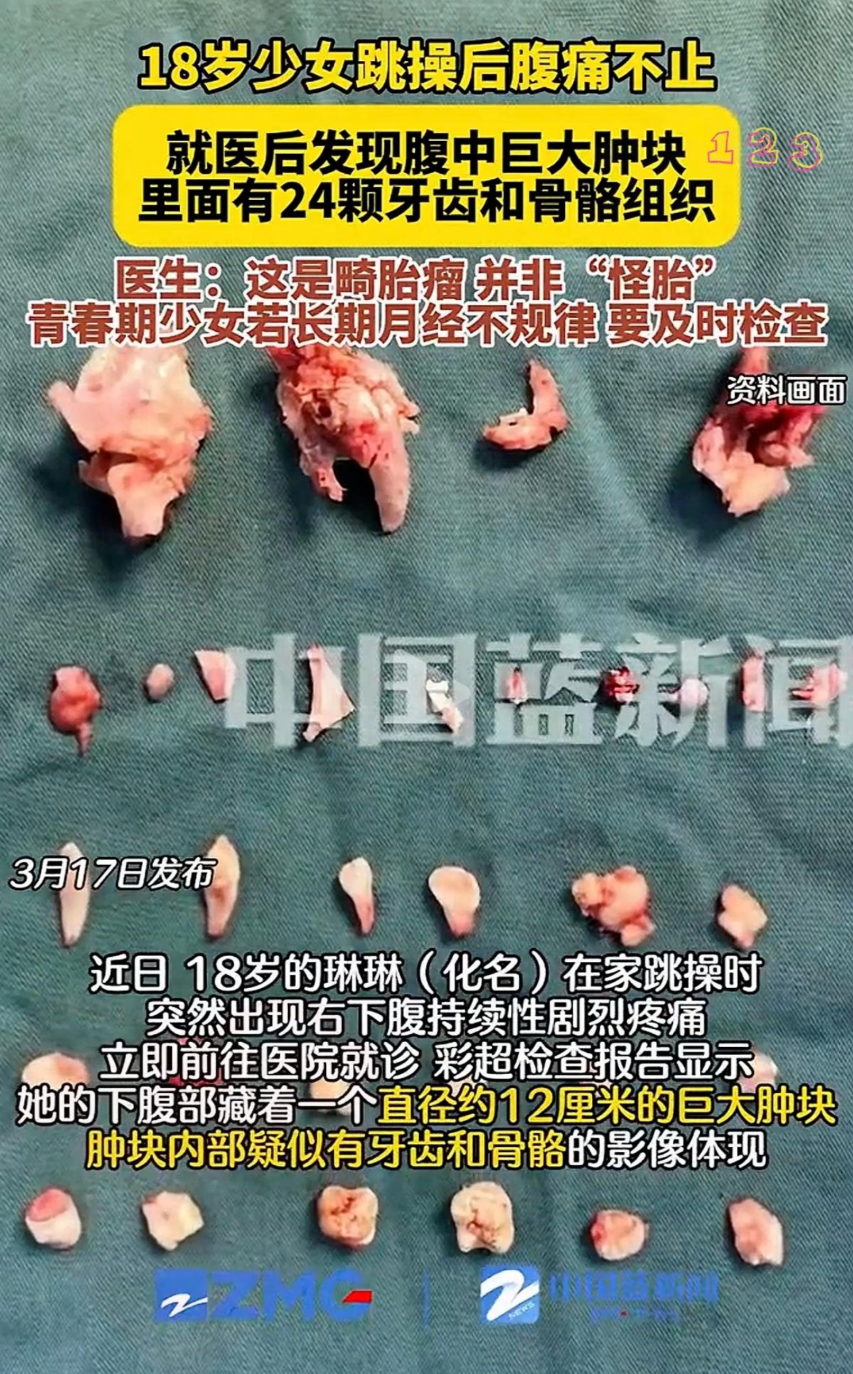 18岁女生腹中肿块，竟取出24颗牙齿，看完真相既后怕又让人警醒。
 
     